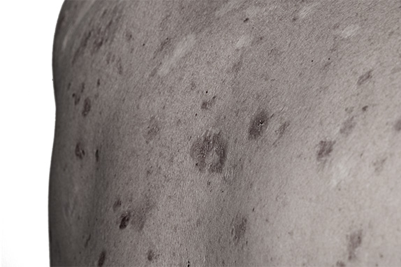 patient image High-frequency BCC